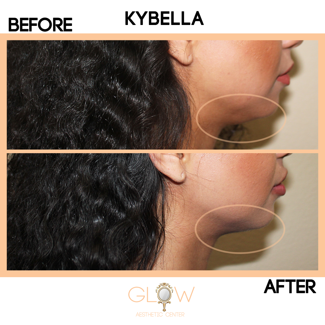Kybella Before and After, Juvederm/Restylane | Encino, California