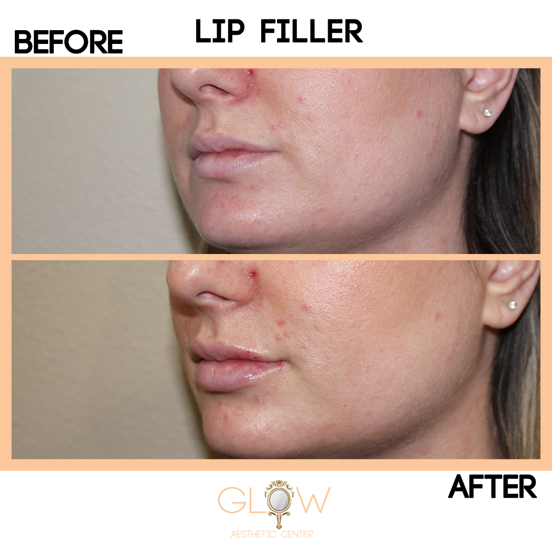 Lip Filler Before and After, Juvederm/Restylane | Encino, California