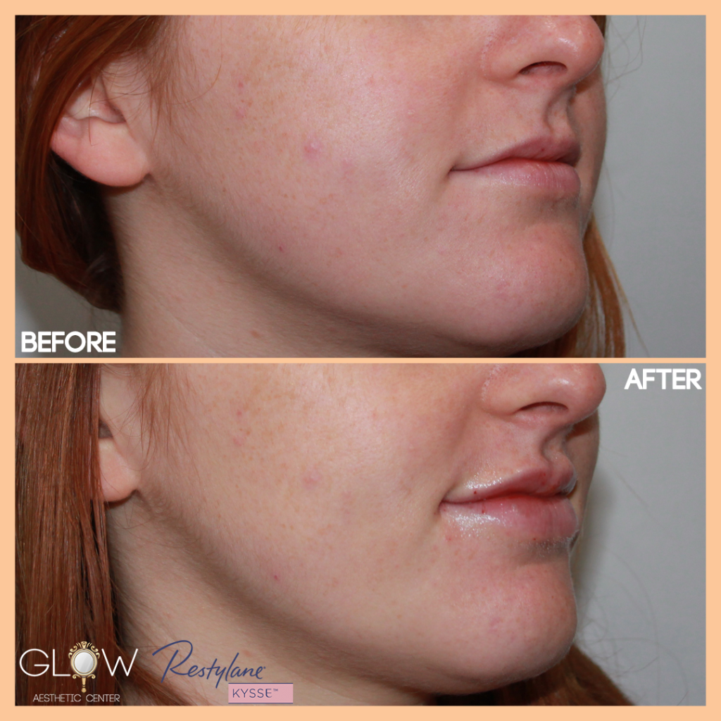 Lip Filler Before and After, Juvederm/Restylane | Encino, California