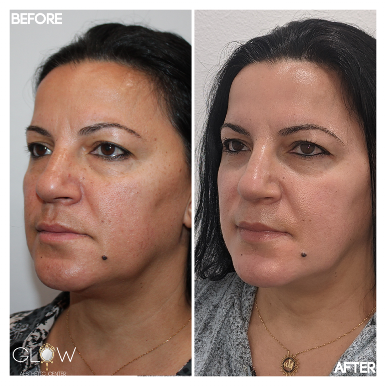 Cosmelan Peel Before and After